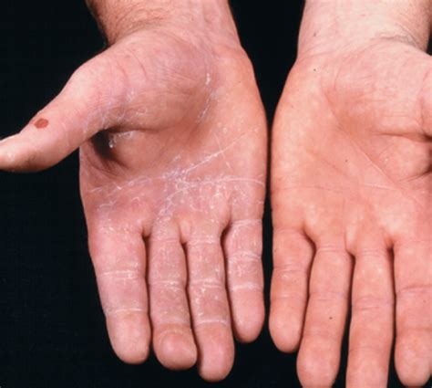 Tinea Manuum Hands Flashcards Quizlet