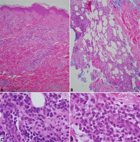 Myeloid Sarcoma Example Of A Case A With Focal Architecture