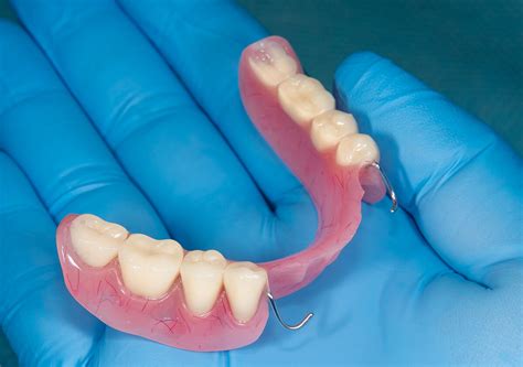 Removable Partial Dentures For Missing Teeth Fallbrook Ca