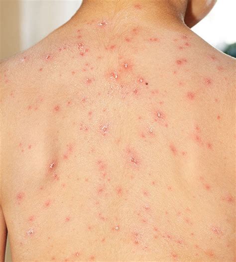What Does Chickenpox Look Like