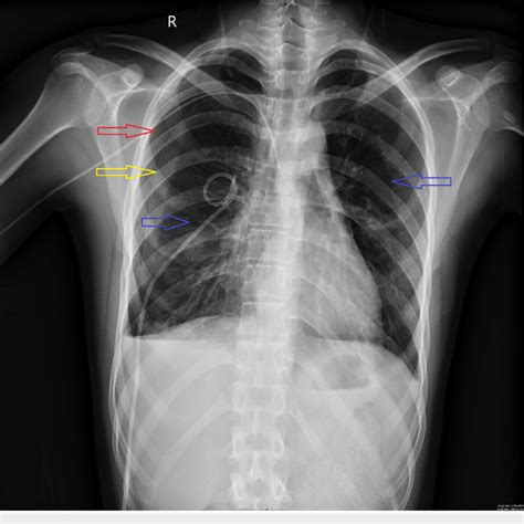 Chest X Ray Lateral View Showing Pneumothorax Download Scientific