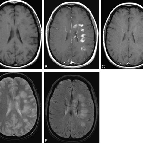Patient 6 With Ms Axial T1 Weighted Images Without A And With B