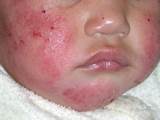 Photos of Weeping Eczema Treatment
