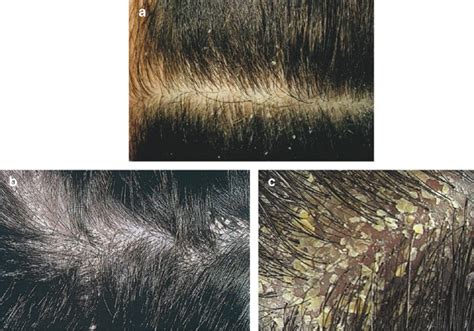 Check out popular dandruff causes so you will be able to prevent and cure it easily. New Ion Ozone Hair Scalp Comb Helps Dandruff Hair Lost ...