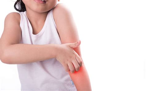 Eczema In Children Dr Joycelim Dermatologist And Skin Specialist