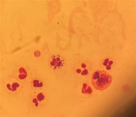 Neisseria Gonorrhoeae In Ascitic Fluid Rclinicalmicrobiology