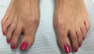 Bunion Mild Surgery Before And After Bunion Doctor Robert Surgery