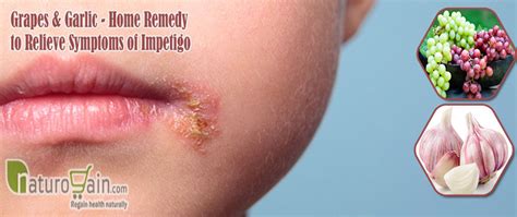 11 Best Home Remedies For Impetigo To Prevent Skin Infection Naturally