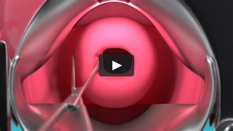 Cervical Laceration Animation On Vimeo