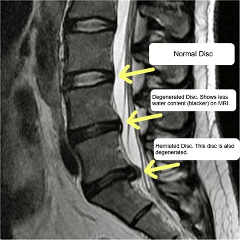 treatment options and pathophysiology of degenerative spine disease surgery oxford