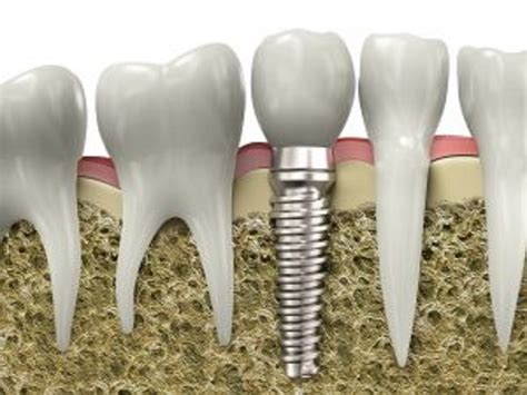 Dental Implant Timeline How Long Do Dental Implant Procedures Take