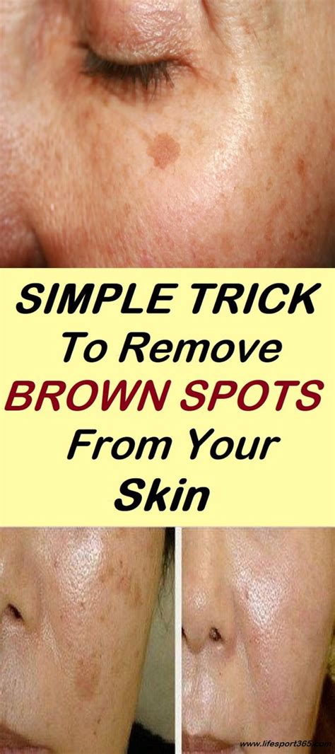 Simple Trick To Remove Brown Spots From Your Skin Lizy Style