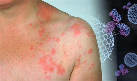 Shingles This Type Of Rash May Reveal Youve Been Infected With The