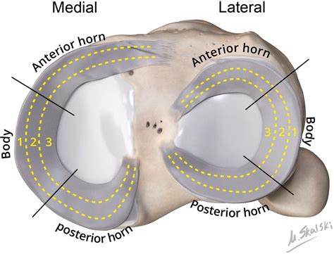 Illustrative Review Of Knee Meniscal Tear Patterns Repair And Replacement Options And Imaging