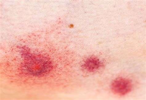 Mosquito Bite Allergy Stock Photos Pictures And Royalty Free Images Istock