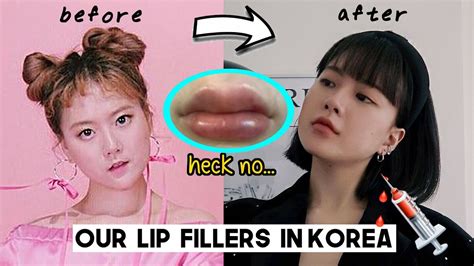 My Lip Filler Journey In Korea Plastic Surgery Clinic Cost Pros And Cons Etc Q2han Youtube