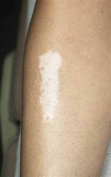 Vitiligo Dermatology Advisor