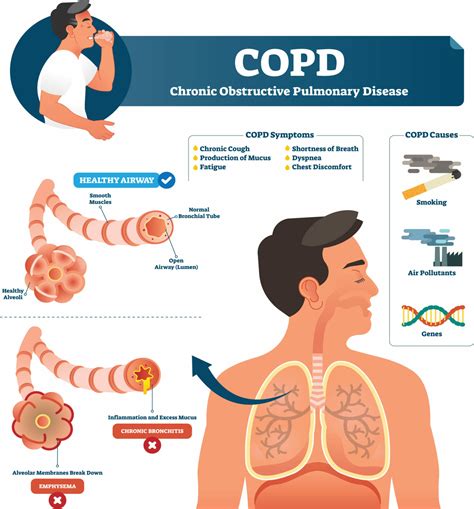Chronic Obstructive Pulmonary Disease Copd Treatment London