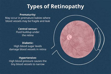 Types Of Retinopathy