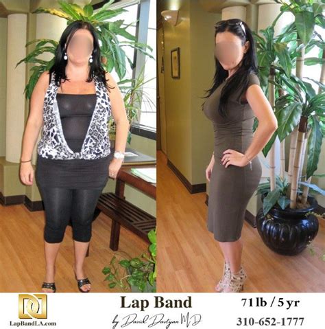 Before And After Lap Band Surgery Patient Testimonials Lap Band Los