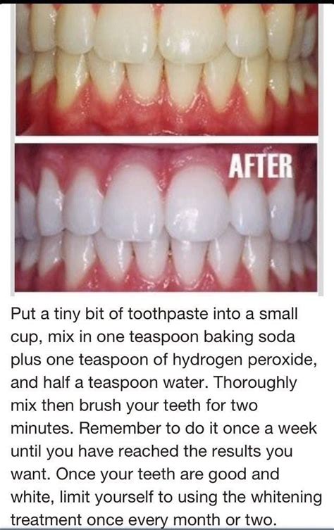 How Long Does It Take To Whiten Teeth With Peroxide Teethwalls