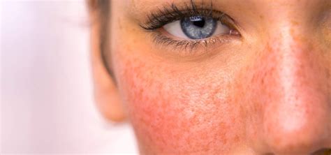 How To Tell If You Have Sensitive Skin South Beach Skin Lab