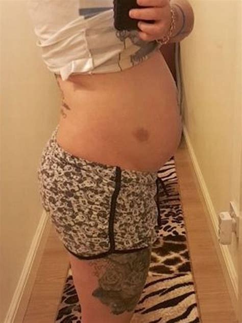 Severe Bloating From Bowel Complications Left Woman Looking Pregnant