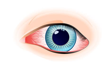 Subconjunctival Hemorrhage Causes And Treatments Dougherty Laser Vision
