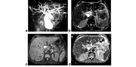A 57 Year Old Man With Cbd Cholangiocarcinoma Extending To Chd A