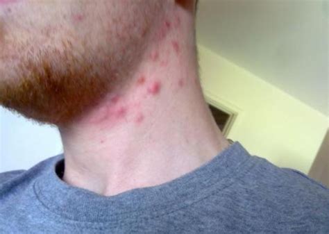Healing Pimples On Neck Front Back Chin And Cheeks