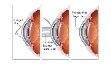 Refractive Surgery In Delhi Best Eye Specialist Dr Anisha Gupta