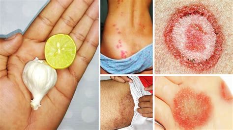 How To Treat Private Part Itching Fungal Infection Fungal Ringworm