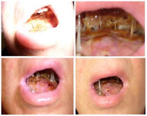 Senzaţie de uscare a gurii, datorită unei insuficiente salivaţii. Alternative Mundpflege im palliativen Setting » KAI Kongress