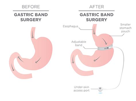 Laparoscopic Adjustable Gastric Band And Banded Sleeve At Coms Clinic