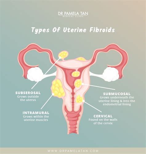 What Are Fibroids Uterine Fibroids Symptoms And My XXX Hot Girl