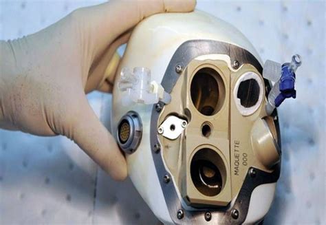 75 Year Old French Man Receives The Worlds First Artificial Heart
