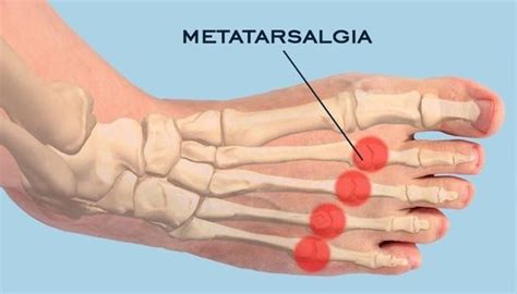 Foot Pain Identifier Chart Metatarsalgia