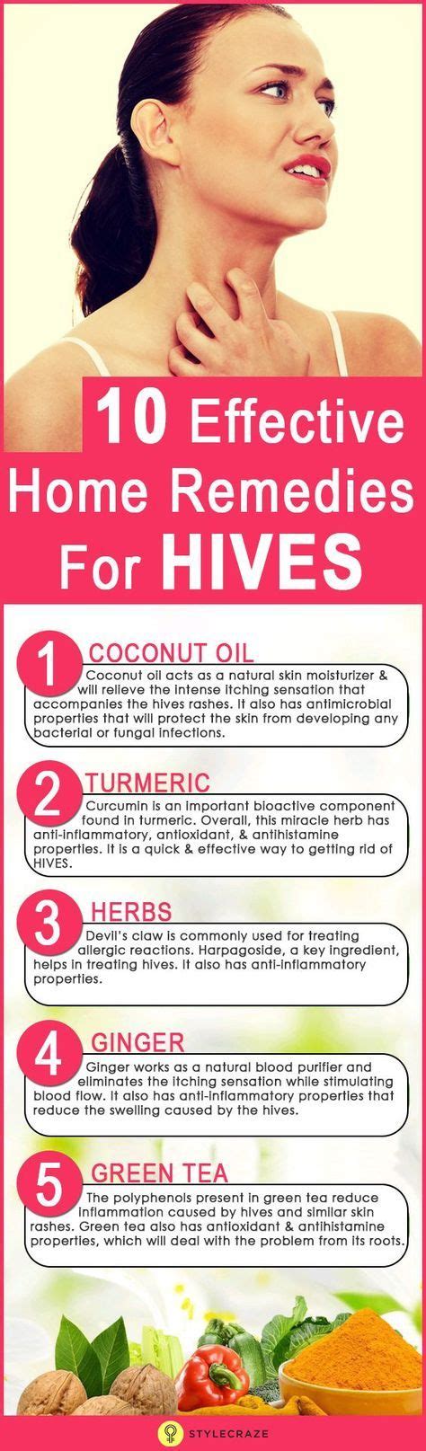 How To Get Rid Of Hives Home Remedies For Hives Hives Remedies