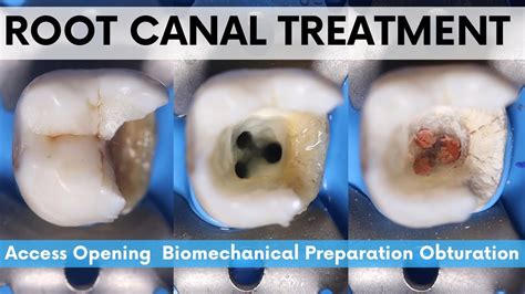 Root Canal TreatmentMandibular Nd MolarAccess Opening Biomechanical