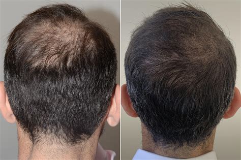 Patient 59563 Foundation For Hair Restoration