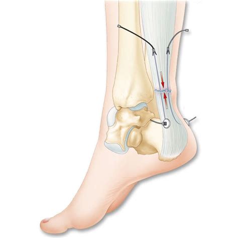 Sie verbindet die wichtigsten beugemuskeln des unterschenkels mit dem dorsalen teil des fußskeletts und ermöglicht dadurch die. Achillessehne-Bandersatz - TENOLIG - FH Orthopedics ...