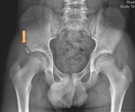 Anteroposterior Radiograph Of A Right Hip Anterior Inferior Iliac Spine