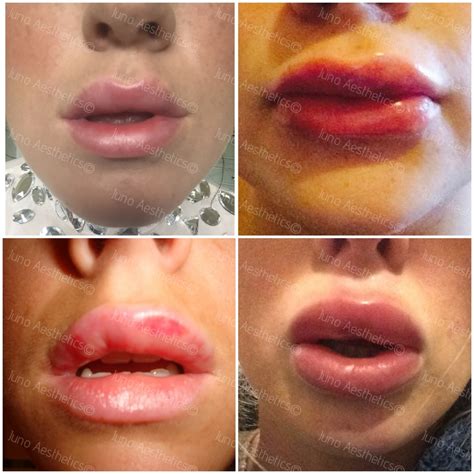 Lip Filler — Blog — Juno Aesthetics