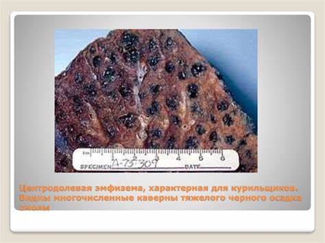 Эмфизема легких диета Эмфизема легких - презентация онлайн Эмфизема легких - презентация онлайн Эмфизема легких диета