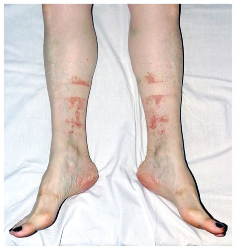 Hikers Rash Exercise Induced Vasculitis