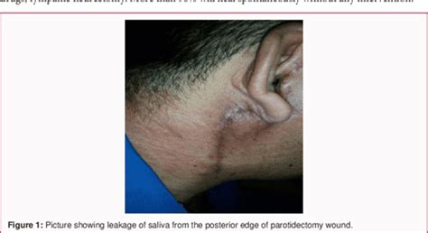 Pdf Rare Parotid Salivary Fistula Post Superficial Parotidectomy