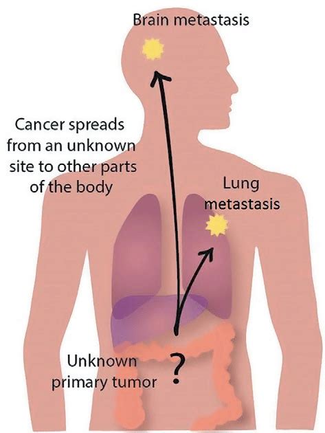 Distant Metastasis Pattern For Cancers Of An Unknown Primary Site