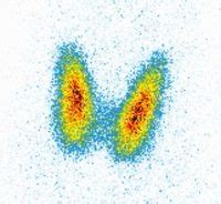 ] nuklearmedizin.nuklearmedizinisches untersuchungsverfahren, bei dem durch einverleibung von radioindikatoren u.und anschließende registrierung u.und aufzeichnung (szintigramm). Schilddrüsenszintigramm