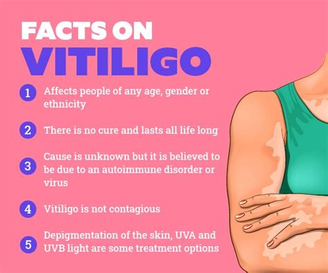 What Is Vitiligo And The Best Treatments For Vitiligo Portal Beauty