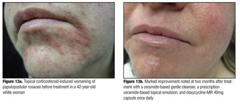 Management Of Papulopustular Rosacea And Perioral Dermatitis With